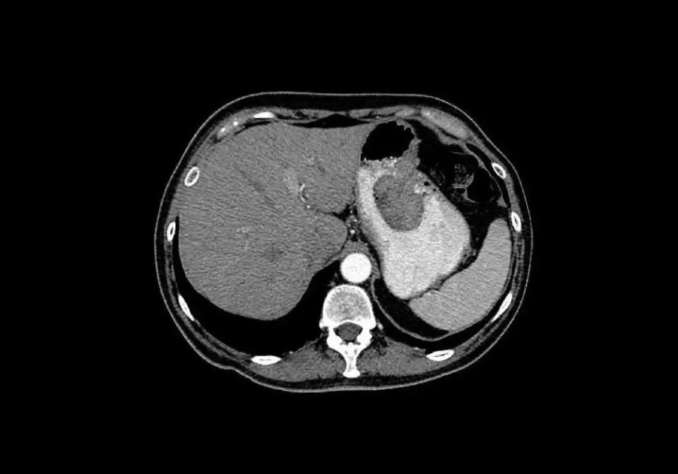 6 loại thực phẩm l&agrave; thủ phạm "th&uacute;c đẩy ung thư", nhiều người vẫn v&ocirc; t&igrave;nh ăn tới 5 loại- Ảnh 2.