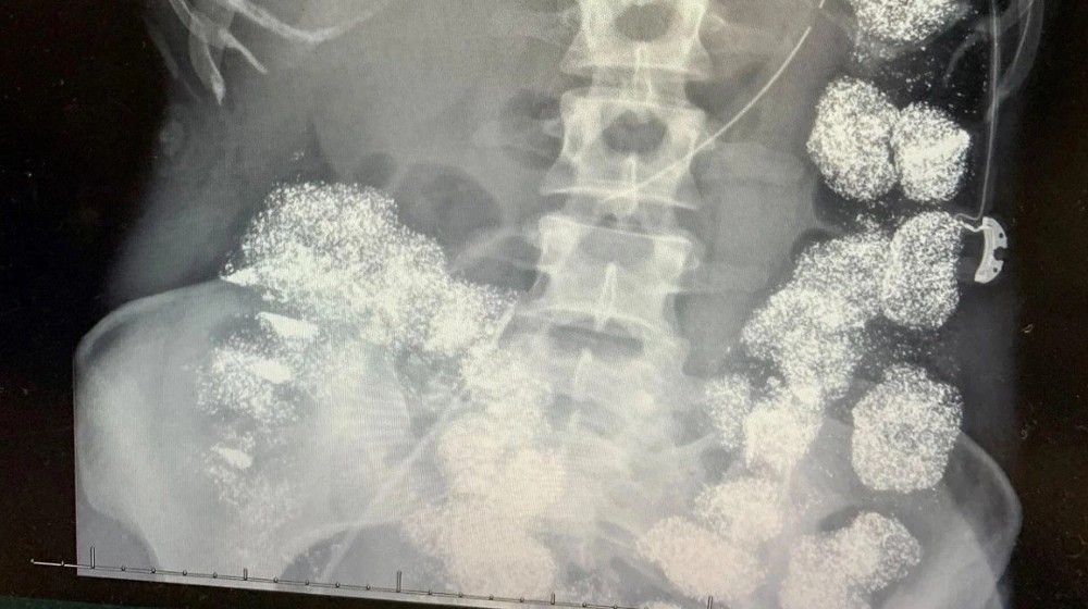 Vụ đầu độc bằng ch&igrave; trong gia đ&igrave;nh b&aacute;c sĩ: &Acirc;m mưu chiếm đoạt tiền bảo hiểm- Ảnh 2.