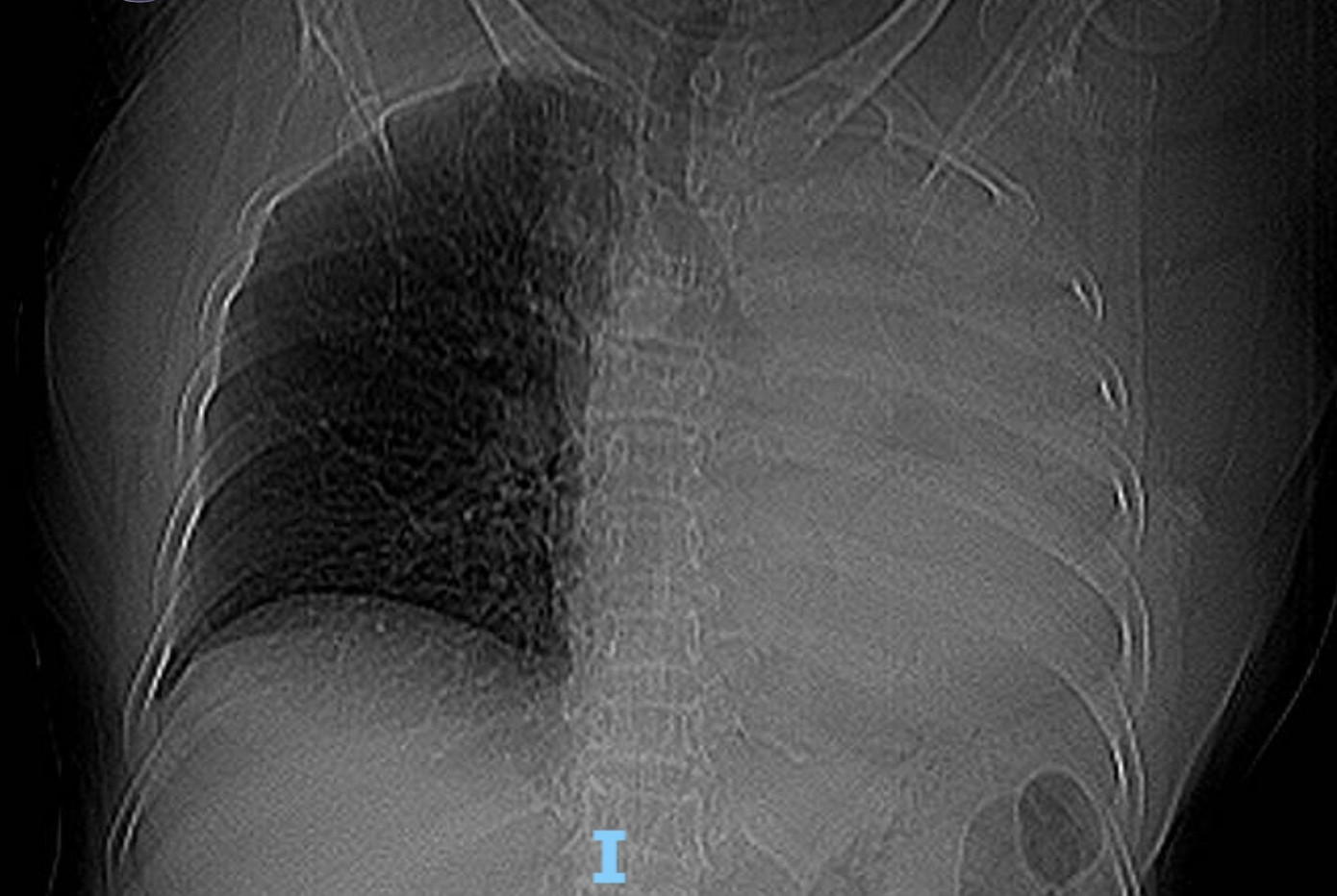 Sặc một vi&ecirc;n thuốc, cụ b&agrave; xẹp to&agrave;n bộ phổi tr&aacute;i- Ảnh 1.