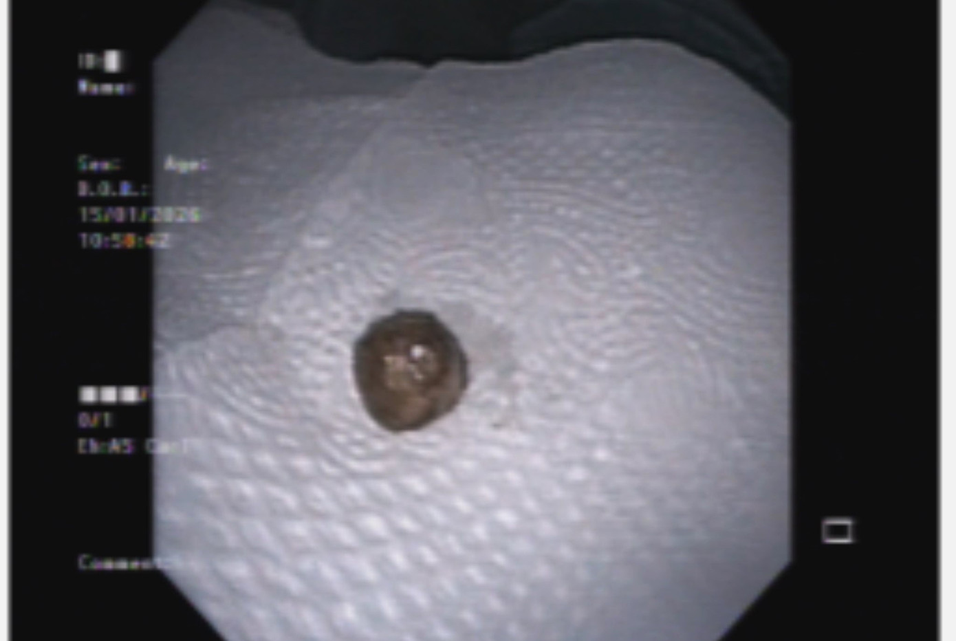 Sặc một vi&ecirc;n thuốc, cụ b&agrave; xẹp to&agrave;n bộ phổi tr&aacute;i- Ảnh 2.