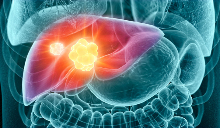 Cảnh b&aacute;o 4 dấu hiệu sớm nhất của ung thư gan- Ảnh 5.