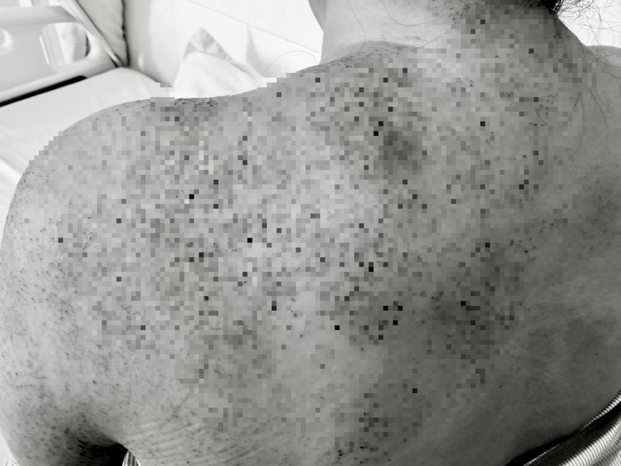 Người phụ nữ nhập viện cấp cứu sau khi ch&iacute;ch lể, gi&aacute;c hơi- Ảnh 1.