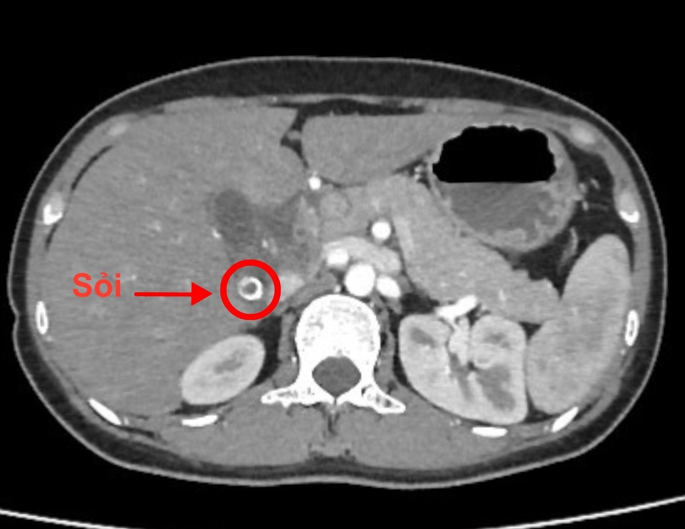Người phụ nữ trẻ su&yacute;t mất mạng sau 3 ng&agrave;y tự điều trị đau bụng- Ảnh 1.