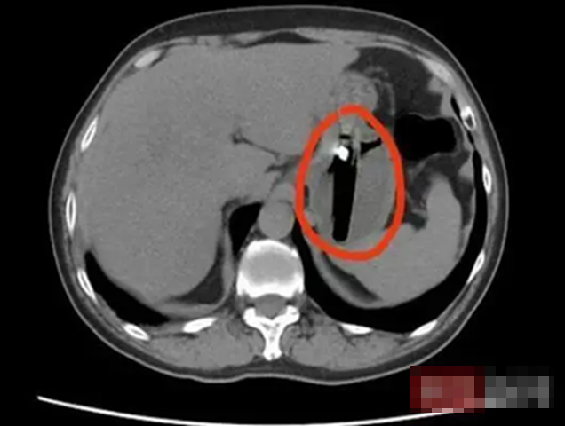 Người đàn ông 36 tuổi đau bụng dữ dội, đi khám phát hiện thứ "lạ đời" không ai nghĩ được nó nằm bên trong- Ảnh 1.