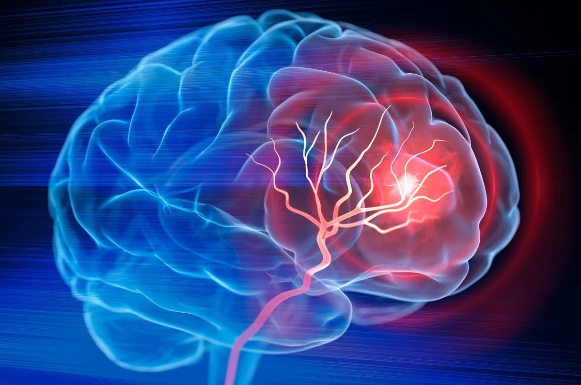 Mỹ ph&aacute;t triển phương ph&aacute;p trị đột quỵ mới, chỉ cần 1 lần truyền dịch- Ảnh 1.