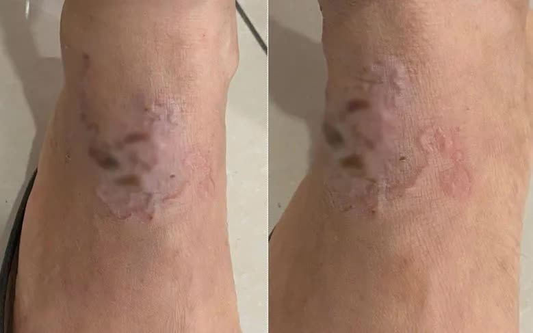 Ấu tr&ugrave;ng "vẽ đường" ngoằn ngo&egrave;o dưới da người phụ nữ- Ảnh 1.