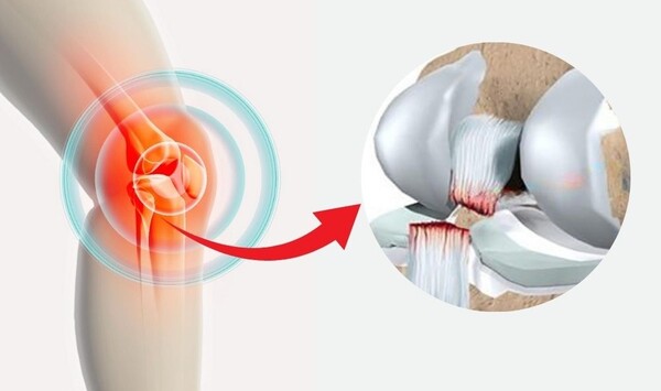 Hiểu Minh bị đứt d&acirc;y chằng ch&eacute;o trước: B&aacute;c sĩ n&oacute;i nếu l&agrave;m được điều n&agrave;y sẽ phục hồi được 80% sau&hellip; 1 năm- Ảnh 3.