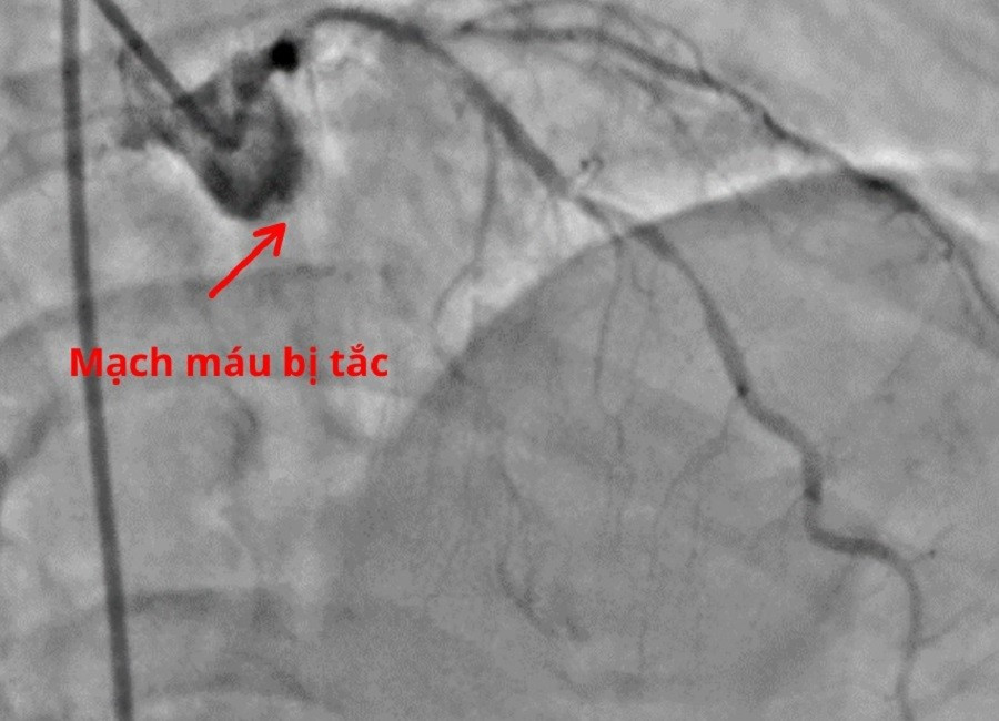 Chết l&acirc;m s&agrave;ng v&igrave; bỏ qua dấu hiệu cảnh b&aacute;o nhồi m&aacute;u cơ tim cấp- Ảnh 1.