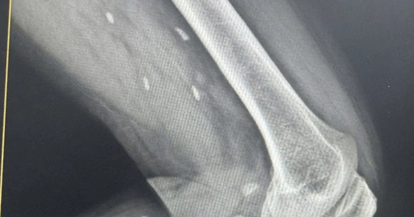 Th&oacute;i quen nhiều người Việt m&ecirc; mẩn khiến s&aacute;n &ldquo;l&agrave;m tổ&rdquo; dưới da m&agrave; kh&ocirc;ng hay biết