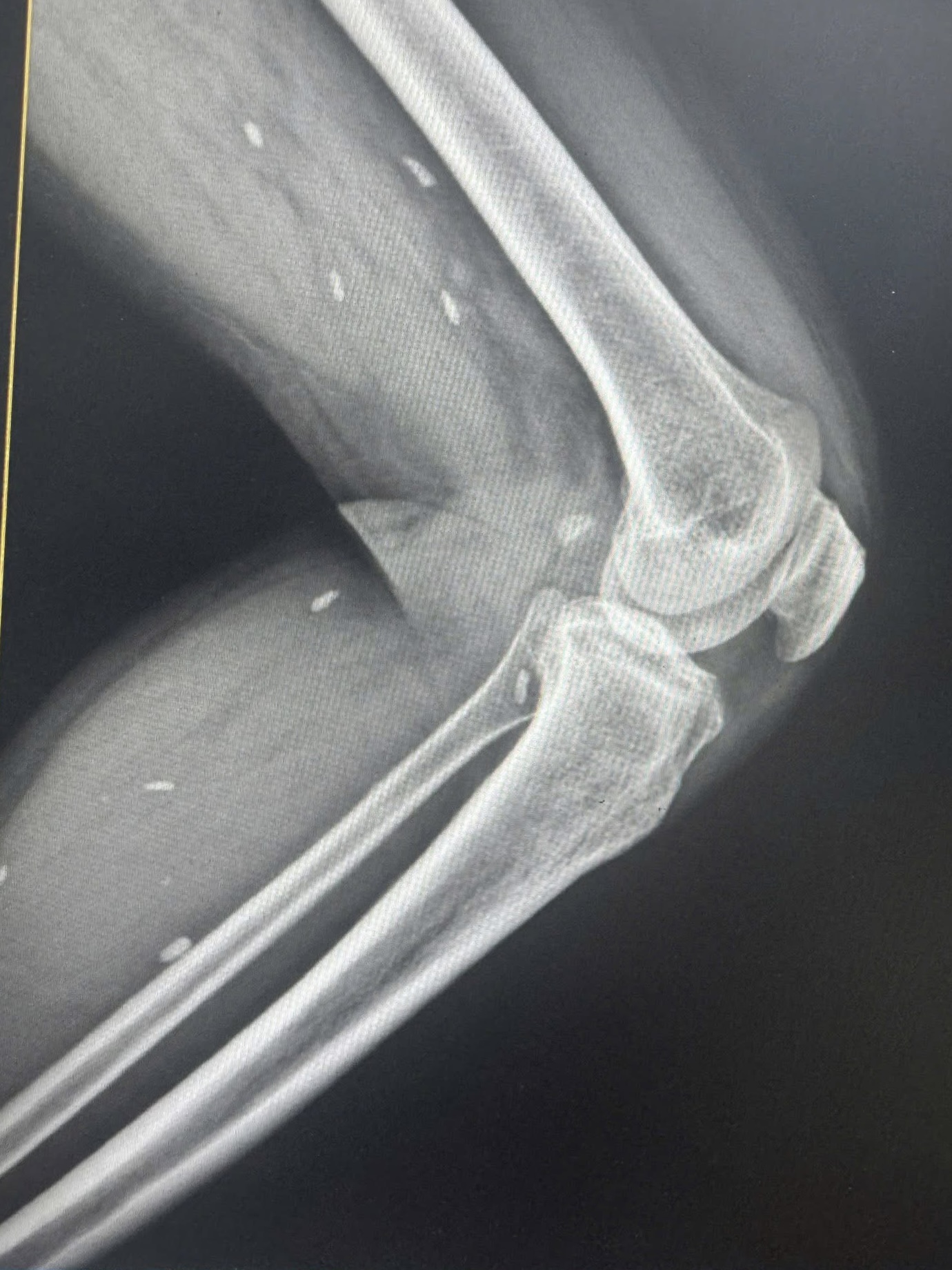 Th&oacute;i quen nhiều người Việt m&ecirc; mẩn khiến s&aacute;n &ldquo;l&agrave;m tổ&rdquo; dưới da m&agrave; kh&ocirc;ng hay biết- Ảnh 1.