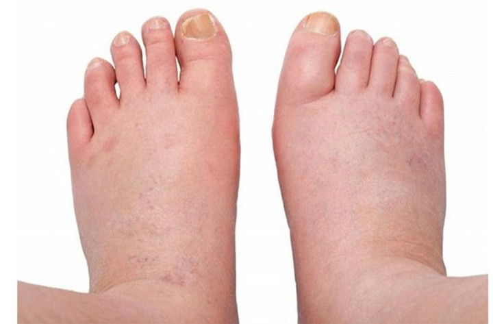 B&agrave;n ch&acirc;n xuất hiện những dấu hiệu n&agrave;y, thận c&oacute; thể đang 'k&ecirc;u cứu'- Ảnh 1.