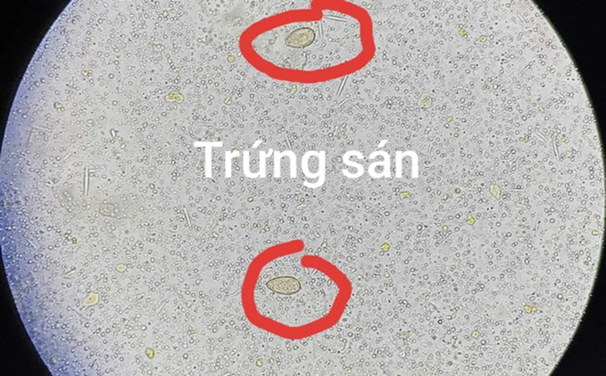 Đau bụng đi kh&aacute;m, người đ&agrave;n &ocirc;ng 64 tuổi sốc ngang khi thấy ở s&aacute;n trong người- Ảnh 1.