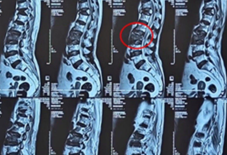 Bơm &lsquo;xi măng&rsquo; v&agrave;o đốt sống cứu cụ b&agrave; 100 tuổi- Ảnh 1.