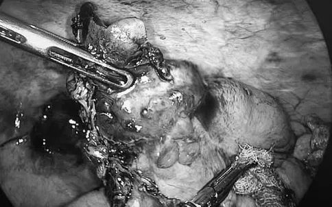 Ph&aacute;t hiện ung thư ruột thừa hiếm gặp khi mổ vi&ecirc;m ruột thừa- Ảnh 1.