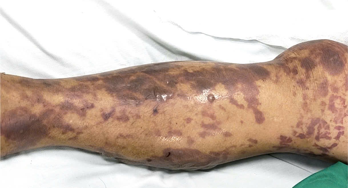 Người đ&agrave;n &ocirc;ng 52 tuổi mắc phải bệnh truyền nhiễm nguy hiểm, l&acirc;y lan nhanh v&agrave; nguy cơ tử vong cao: Thủ phạm thực sự g&acirc;y bất ngờ- Ảnh 3.