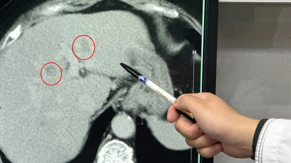 Người phụ nữ 60 tuổi mắc ung thư gan, một nửa gan l&agrave; mỡ v&igrave; ng&agrave;y n&agrave;o cũng ăn 2 m&oacute;n 