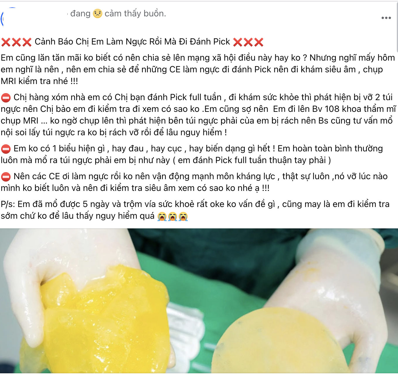 Cảnh b&aacute;o của "nữ pick thủ" vỡ t&uacute;i độn ngực: Đừng chủ quan khi chơi pickleball- Ảnh 1.