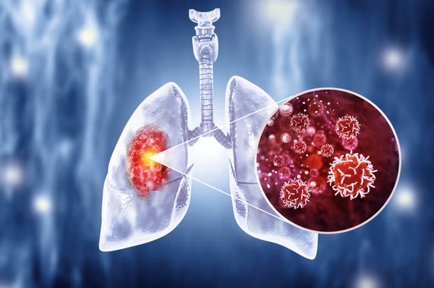 Hai vợ chồng c&ugrave;ng mắc ung thư phổi, tử vong c&aacute;ch nhau 1 th&aacute;ng - &ldquo;Mọi chuyện v&ocirc; c&ugrave;ng t&agrave;n khốc&rdquo;- Ảnh 2.