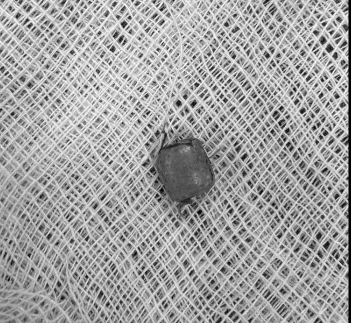 B&eacute; 10 tuổi &ugrave; tai k&eacute;o d&agrave;i, b&aacute;c sĩ lấy ra thứ "đ&aacute;ng sợ" b&ecirc;n trong- Ảnh 1.