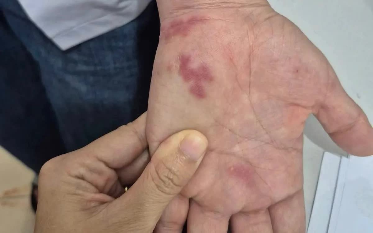 Nguy hiểm: Nhiễm vi khuẩn "ăn thịt người" sau khi bị v&acirc;y c&aacute; đ&acirc;m- Ảnh 1.