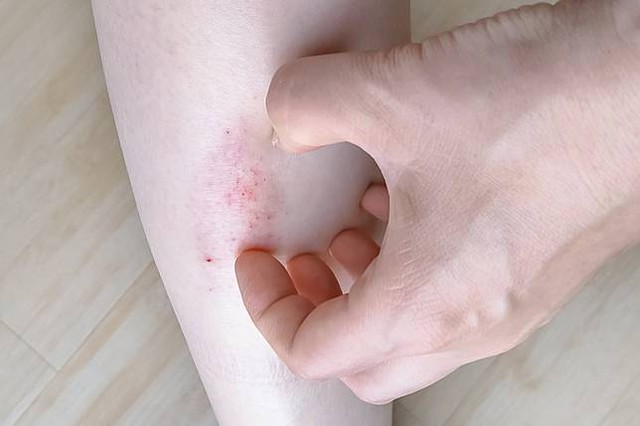 Người đ&agrave;n &ocirc;ng 40 tuổi ph&aacute;t hiện ung thư gan giai đoạn cuối: Đ&aacute;ng tiếc &ocirc;ng đ&atilde; bỏ qua dấu hiệu suốt 3 th&aacute;ng- Ảnh 2.