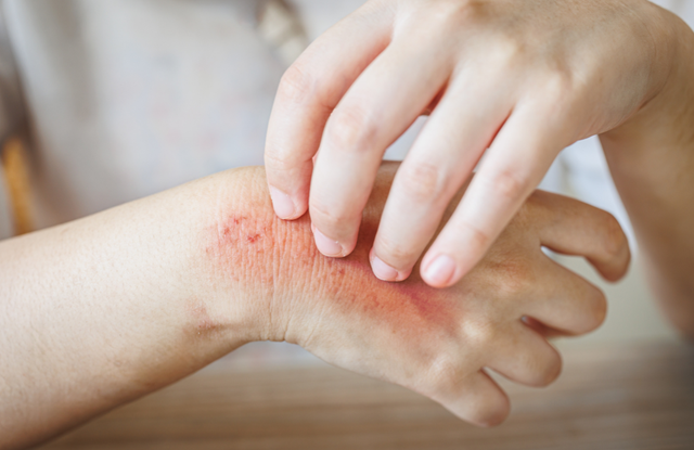 Người đ&agrave;n &ocirc;ng 40 tuổi ph&aacute;t hiện ung thư gan giai đoạn cuối: Đ&aacute;ng tiếc &ocirc;ng đ&atilde; bỏ qua dấu hiệu suốt 3 th&aacute;ng- Ảnh 4.