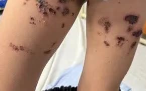 Cảnh b&aacute;o bỏng h&oacute;a chất từ nước tẩy bồn cầu trong gia đ&igrave;nh- Ảnh 1.