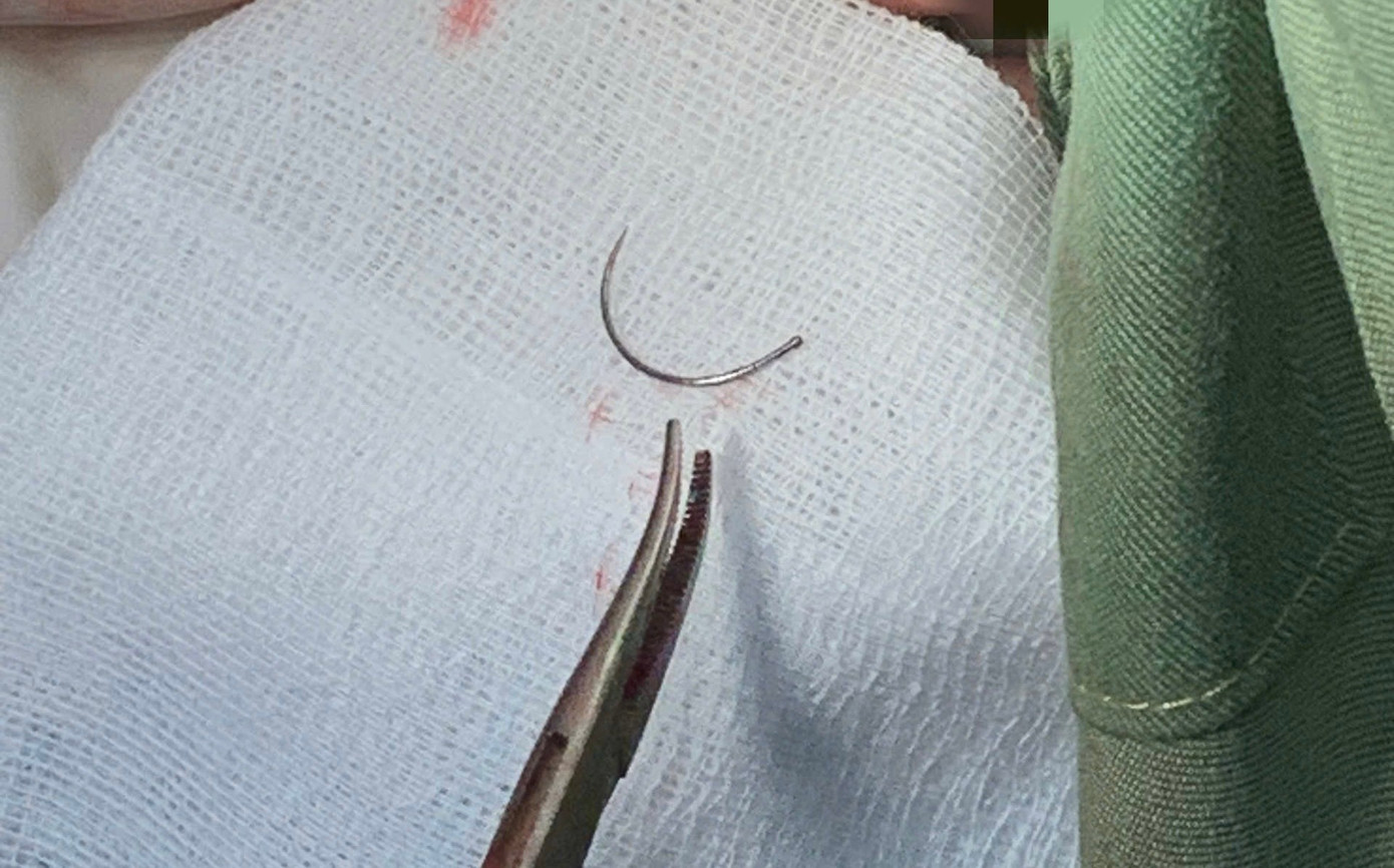 Kim kh&acirc;u bị &lsquo;bỏ qu&ecirc;n&rsquo; trong cơ thể người phụ nữ suốt 11 năm- Ảnh 2.