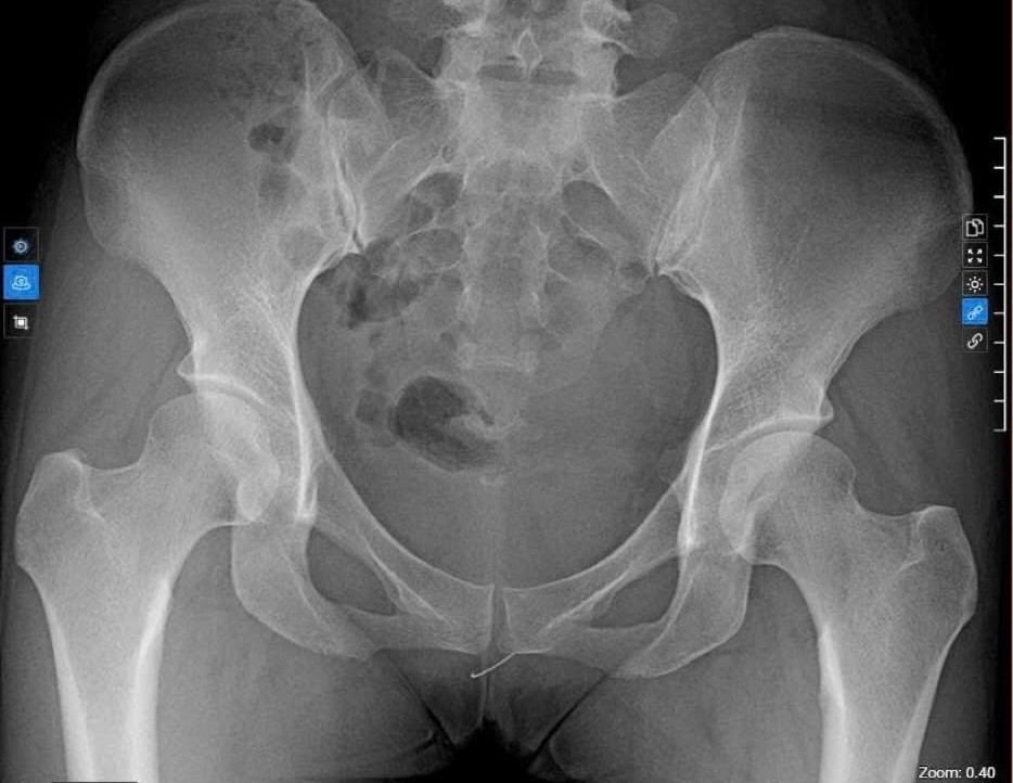 Kim kh&acirc;u bị &lsquo;bỏ qu&ecirc;n&rsquo; trong cơ thể người phụ nữ suốt 11 năm- Ảnh 1.