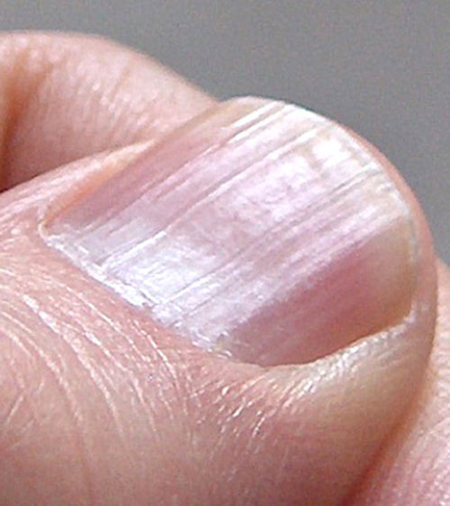 M&oacute;ng tay nổi sọc dọc, cảnh b&aacute;o dấu hiệu bất thường vấn đề sức khỏe- Ảnh 3.