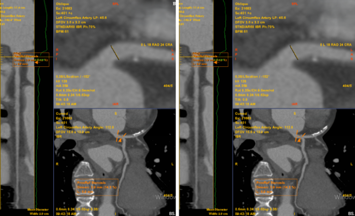 Chỉ đau tức ngực tr&aacute;i tho&aacute;ng qua, kh&ocirc;ng ngờ ph&aacute;t hiện bệnh l&yacute; tim mạch nguy hiểm- Ảnh 1.