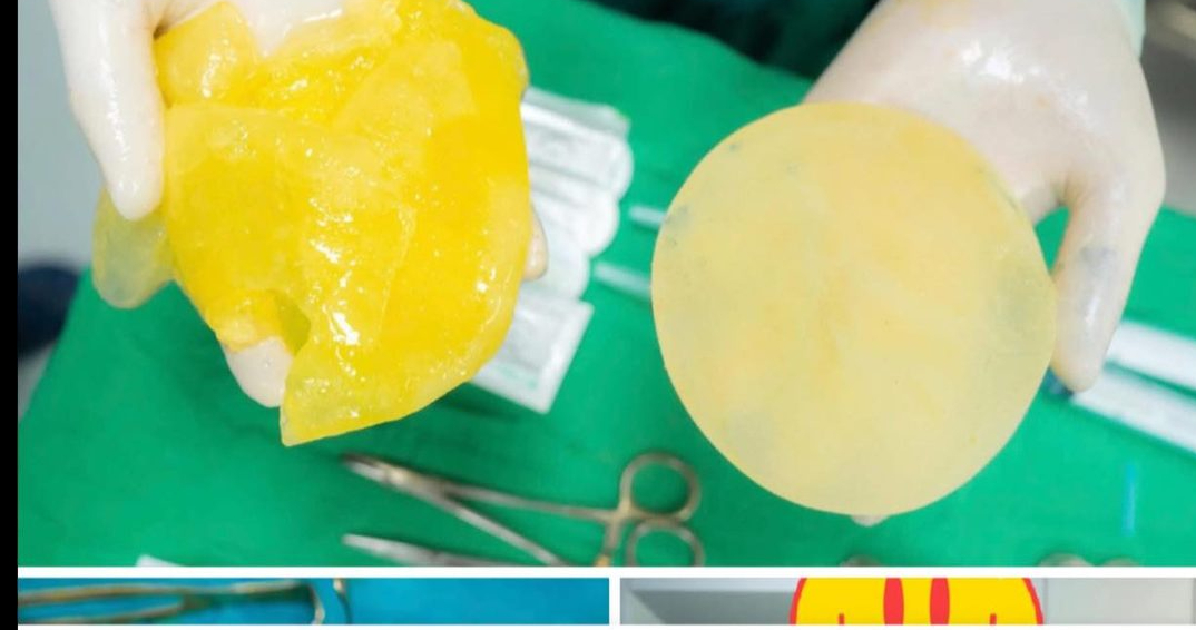 Phụ nữ đ&atilde; "tr&ugrave;ng tu" v&ograve;ng 1 c&oacute; n&ecirc;n chơi pickleball?- Ảnh 2.