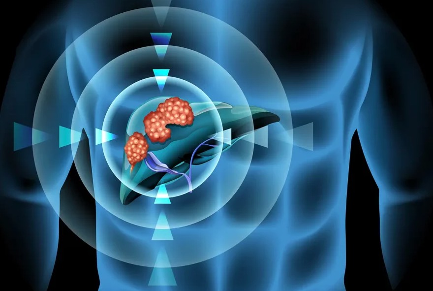 Khối u gan 6 cm đột nhi&ecirc;n biến mất sau khi chuyện n&agrave;y xảy ra- Ảnh 1.