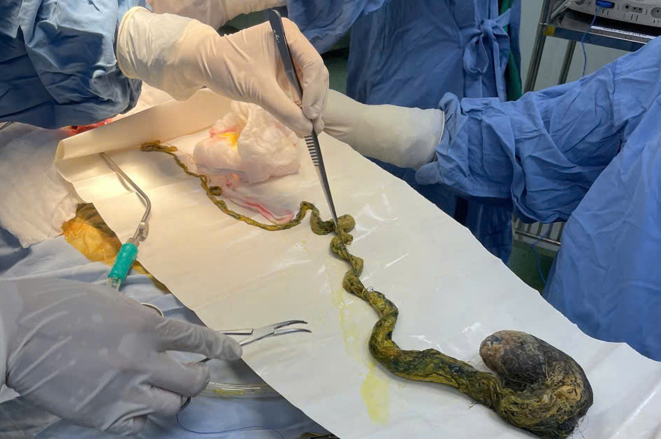 B&eacute; trai phải l&ecirc;n b&agrave;n mổ v&igrave; ăn t&oacute;c, b&aacute;c sĩ cảnh b&aacute;o t&igrave;nh trạng y khoa hiếm gặp- Ảnh 2.
