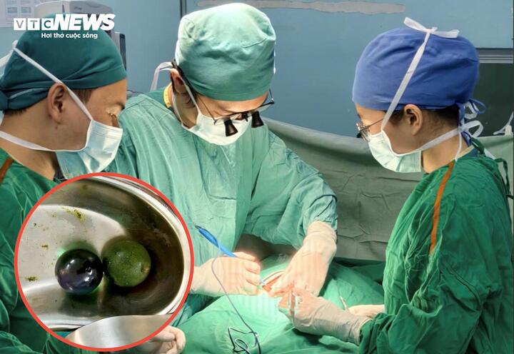 B&eacute; g&aacute;i 18 th&aacute;ng tuổi nguy kịch, ruột tắc nghẽn v&igrave; nuốt hạt nở đồ chơi- Ảnh 1.