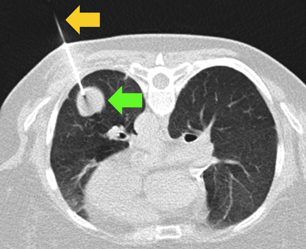 5 vị trí trên cơ thể mà tế bào ung thư "ĐẶC BIỆT YÊU THÍCH", đáng sợ là khám sức khỏe định kỳ vẫn dễ lọt khối u- Ảnh 1. 5 vị trí trên cơ thể mà tế bào ung thư "ĐẶC BIỆT YÊU THÍCH", đáng sợ là khám sức khỏe định kỳ vẫn dễ lọt khối u- Ảnh 1.
