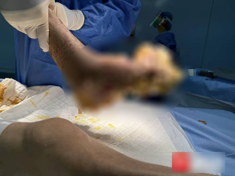 Người đ&agrave;n &ocirc;ng su&yacute;t mất cả b&agrave;n ch&acirc;n v&igrave; nhiễm HPV- Ảnh 1.