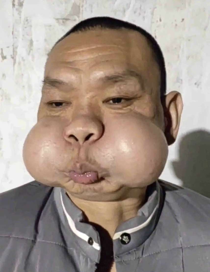 30 năm thổi thủy tinh, gương mặt biến dạng: Nghệ nh&acirc;n Trung Quốc c&oacute; đ&ocirc;i m&aacute; phồng như &ldquo;ếch&rdquo;, c&aacute;i gi&aacute; kh&ocirc;ng ai muốn trả- Ảnh 1.