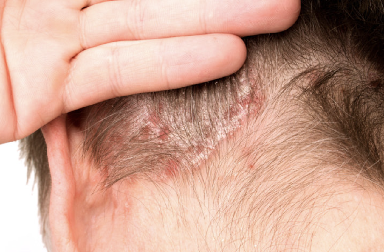 Bệnh tật b&agrave;o m&ograve;n t&uacute;i tiền của c&aacute;c gia đ&igrave;nh: 6 căn bệnh hiện nay kh&ocirc;ng thể chữa khỏi ho&agrave;n to&agrave;n!- Ảnh 2.