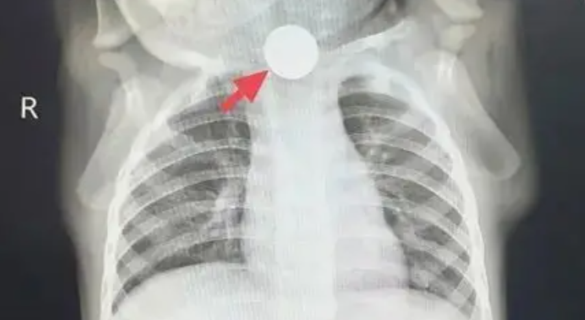 B&eacute; trai 1 tuổi bỏ ăn cả tuần, nguy&ecirc;n nh&acirc;n được ph&aacute;t hiện khiến b&agrave; nội phải thốt l&ecirc;n: "Đ&uacute;ng l&agrave; lỗi của t&ocirc;i"- Ảnh 1.