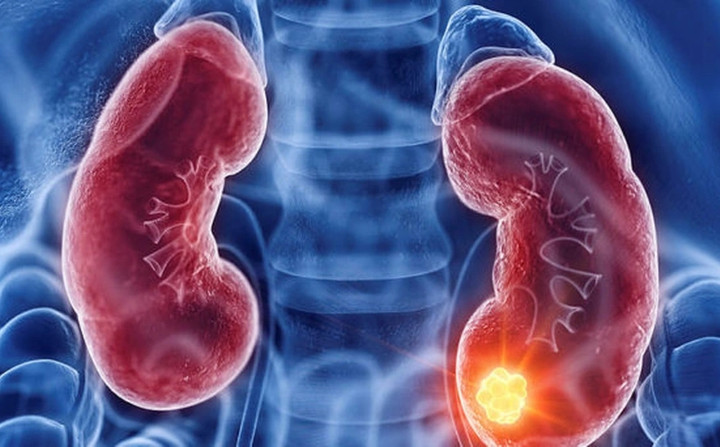 Ung thư thận dễ bị bỏ s&oacute;t, chỉ ph&aacute;t hiện khi trong nước tiểu c&oacute; m&aacute;u- Ảnh 1.