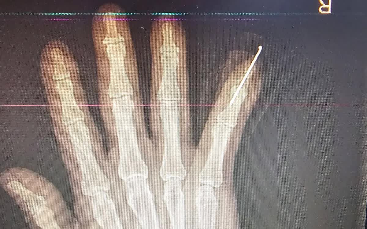 Nối th&agrave;nh c&ocirc;ng ng&oacute;n tay đứt l&igrave;a cho bệnh nh&acirc;n- Ảnh 1.