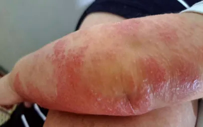 Vi&ecirc;m da cơ địa m&ugrave;a lạnh: Kh&ocirc;ng chủ quan v&agrave; tự &yacute; điều trị- Ảnh 1.