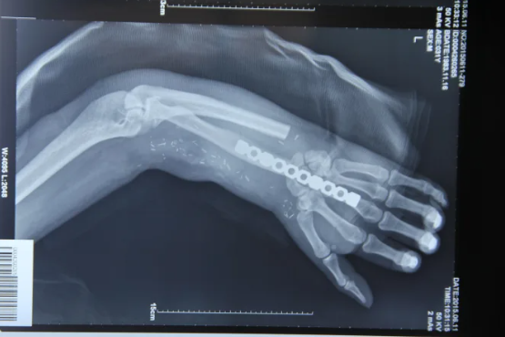 B&aacute;c sĩ cứu b&agrave;n tay bị đứt l&igrave;a của người bệnh bằng c&aacute;ch gh&eacute;p v&agrave;o ch&acirc;n- Ảnh 3.