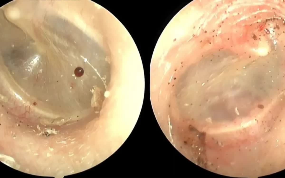 Đau, kh&oacute; chịu tai k&eacute;o d&agrave;i, ph&aacute;t hiện bọ ch&oacute; sống trong tai- Ảnh 1.