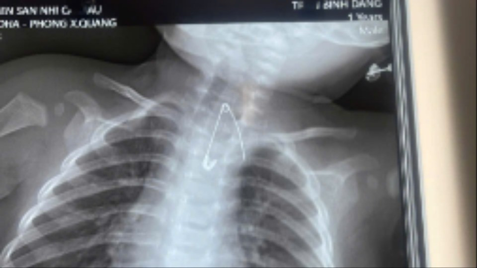 Trẻ bị thủng t&aacute; tr&agrave;ng v&igrave; nuốt que kẹo m&uacute;t- Ảnh 1.