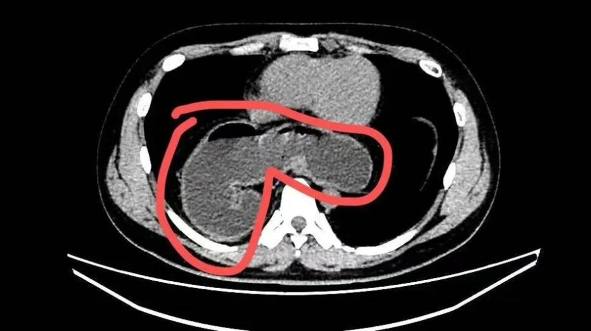 Ch&agrave;ng trai 28 tuổi một nửa dạ d&agrave;y 