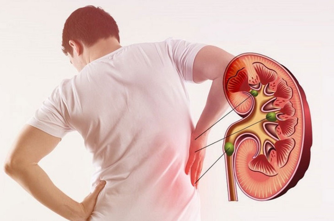 Hướng dẫn phân biệt màu nước tiểu khi thận suy?- Ảnh 2. Hướng dẫn phân biệt màu nước tiểu khi thận suy?- Ảnh 2.