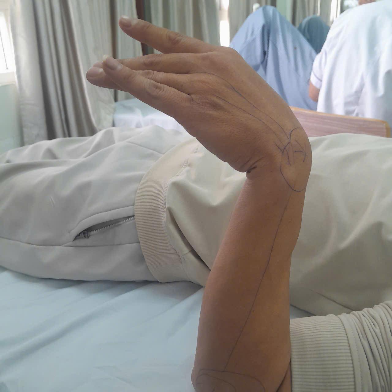 Ngủ gật 30 ph&uacute;t trong giờ l&agrave;m, người đ&agrave;n &ocirc;ng 37 tuổi bỗng liệt d&acirc;y thần kinh, kh&ocirc;ng nhấc nổi cổ tay- Ảnh 2.