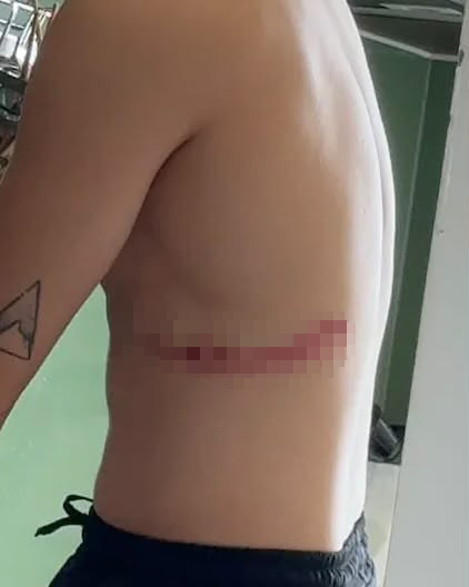 Nam ca sĩ Việt ng&atilde; nh&agrave;o tr&ecirc;n s&acirc;n khấu, nhập viện khẩn v&igrave; g&atilde;y xương sườn- Ảnh 3.